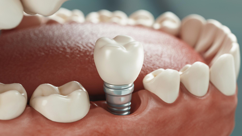 Dental Implants in Jackson